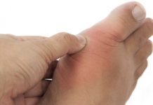 Många patienter får ej läkemedel mot gikt