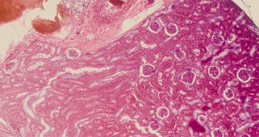 Njursjukdom lika vanligt som typ 2 diabetes