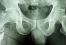 Antidepressiva ökar risken för benbrott hos äldre