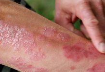 Så ska psoriasis behandlas enligt nya riktlinjer