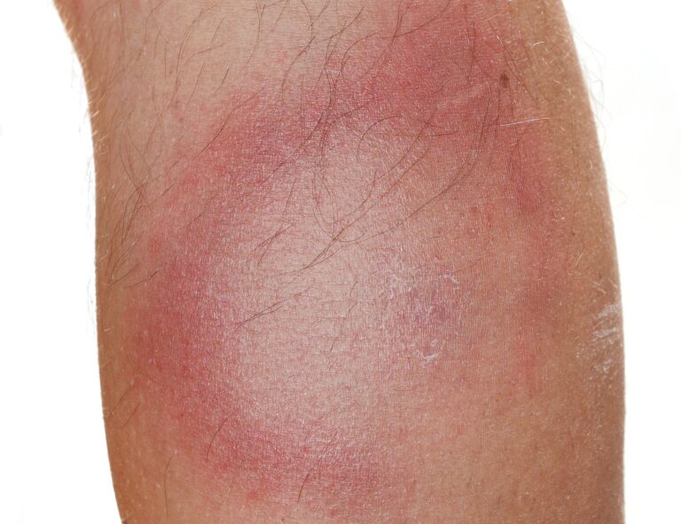 Vaccinkandidat mot borrelia blir försenad