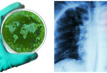 ”Terapi mot resistent tbc når för få” tuberkulos