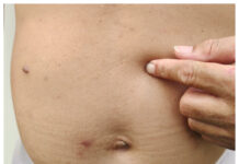 Nu ska ett läkemedel mot fettlever testas Fetma Fettlever WP2 Istock