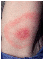 Bilden visar ett exempel på hur ett utslag, så kallat erythema migrans, efter ett ha blivit biten av en borreliasmittad fästing kan se ut. Utslagen kan se olika ut. Just det här kallar amerikanarna ibland för "bulls eye". Foto: CDC/ James Gathany
