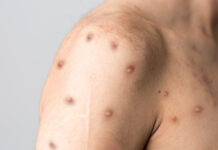 ”Krävs samordnad internationell insats” Läkemedelsvärlden